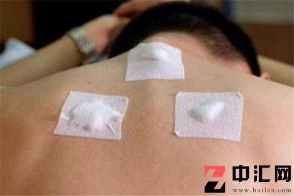 贴过三伏贴后多久可以怀孕 贴三伏贴后怀孕怎么办 贴过三伏贴后多久可以怀孕 贴三伏贴后怀孕怎么办